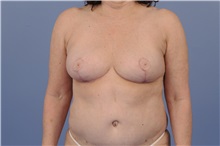 Breast Reduction After Photo by Trent Douglas, MD; Knoxville, TN - Case 31410