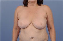 Breast Reduction Before Photo by Trent Douglas, MD; Knoxville, TN - Case 31410
