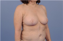 Breast Reduction After Photo by Trent Douglas, MD; Knoxville, TN - Case 31410