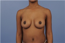 Body Contouring After Photo by Trent Douglas, MD; Knoxville, TN - Case 31415