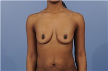 Body Contouring Before Photo by Trent Douglas, MD; Knoxville, TN - Case 31415