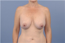 Body Contouring Before Photo by Trent Douglas, MD; Knoxville, TN - Case 31417