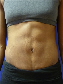 Liposuction After Photo by Mark Markarian, MD, MSPH, FACS; Wellesley, MA - Case 31768