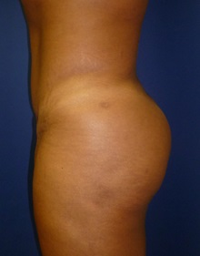 Buttock Lift with Augmentation After Photo by Mark Markarian, MD, MSPH, FACS; Wellesley, MA - Case 31809