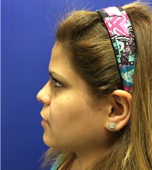 Dermal Fillers After Photo by Mark Markarian, MD, MSPH, FACS; Wellesley, MA - Case 31840