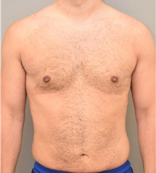 Male Breast Reduction After Photo by Keshav Magge, MD; Bethesda, MD - Case 32232