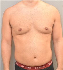 Male Breast Reduction Before Photo by Keshav Magge, MD; Bethesda, MD - Case 32232