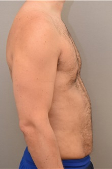 Male Breast Reduction After Photo by Keshav Magge, MD; Bethesda, MD - Case 32232