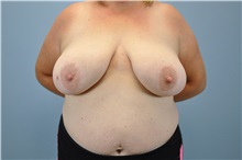 Breast Reconstruction Before Photo by Paul Vanek, MD, FACS; Concord, OH - Case 32800
