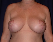 Breast Lift After Photo by Gary Culbertson, MD, FACS; ,  - Case 33316