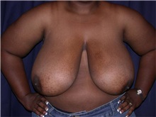 Breast Reduction Before Photo by Gary Culbertson, MD, FACS; ,  - Case 33345