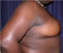 Breast Reduction After Photo by Gary Culbertson, MD, FACS; ,  - Case 33345