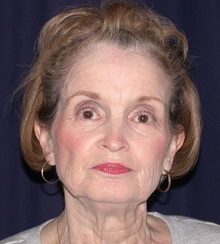 Facelift Before Photo by Gary Culbertson, MD, FACS; ,  - Case 33347