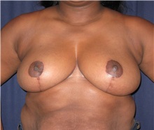 Breast Reduction After Photo by Gary Culbertson, MD, FACS; ,  - Case 33460