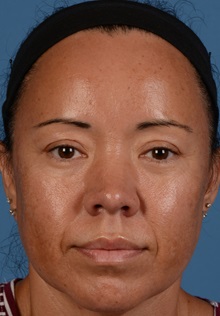 Eyelid Surgery After Photo by Christopher Derderian, MD; ,  - Case 33734