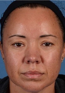 Eyelid Surgery Before Photo by Christopher Derderian, MD; ,  - Case 33734