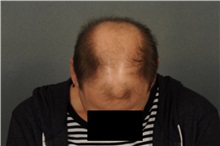 Hair Transplant Before Photo by Ellen Janetzke, MD; ,  - Case 33899