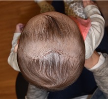 Craniosynostosis After Photo by Rachel Ruotolo, MD; Garden City, NY - Case 34078
