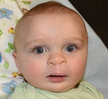 Cleft Lip and Palate Repair After Photo by Rachel Ruotolo, MD; Garden City, NY - Case 34085