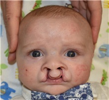 Cleft Lip and Palate Repair Before Photo by Rachel Ruotolo, MD; Garden City, NY - Case 34085