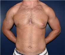 Male Breast Reduction Before Photo by Rachel Ruotolo, MD; Garden City, NY - Case 34209