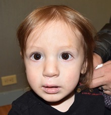 Cleft Lip and Palate Repair After Photo by Rachel Ruotolo, MD; Garden City, NY - Case 34211