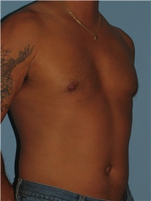 Male Breast Reduction After Photo by Paul Vanek, MD, FACS; Concord, OH - Case 34235