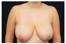 Breast Reduction Before Photo by Michael Law, MD; Raleigh, NC - Case 34244