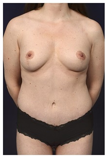 Body Contouring After Photo by Michael Law, MD; Raleigh, NC - Case 34263