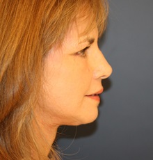 Facelift After Photo by Steve Laverson, MD, FACS; Rancho Santa Fe, CA - Case 34349