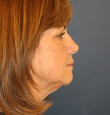 Facelift Before Photo by Steve Laverson, MD, FACS; Rancho Santa Fe, CA - Case 34349