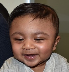 Craniosynostosis After Photo by Rachel Ruotolo, MD; Garden City, NY - Case 35077