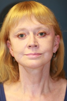 Facelift After Photo by Steve Laverson, MD, FACS; Rancho Santa Fe, CA - Case 35156