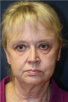 Facelift Before Photo by Steve Laverson, MD, FACS; Rancho Santa Fe, CA - Case 35156