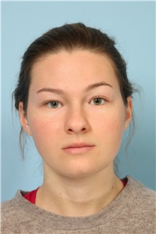 Rhinoplasty Before Photo by Robert Zubowski, MD; ,  - Case 35234