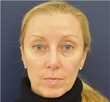 Rhinoplasty After Photo by Richard Reish, MD, FACS; New York, NY - Case 35335