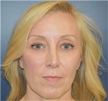 Rhinoplasty Before Photo by Richard Reish, MD, FACS; New York, NY - Case 35335