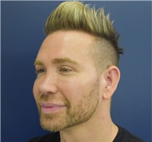 Rhinoplasty After Photo by Richard Reish, MD, FACS; New York, NY - Case 35340