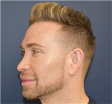 Rhinoplasty Before Photo by Richard Reish, MD, FACS; New York, NY - Case 35340