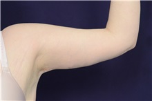 Arm Lift After Photo by Michael Law, MD; Raleigh, NC - Case 35407