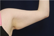 Arm Lift Before Photo by Michael Law, MD; Raleigh, NC - Case 35407