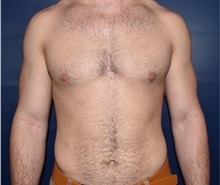 Male Breast Reduction After Photo by Rachel Ruotolo, MD; Garden City, NY - Case 35578
