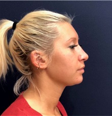 Rhinoplasty After Photo by Pramit Malhotra, MD; Ann Arbor, MI - Case 35695