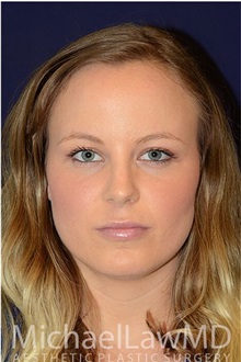 Dermal Fillers After Photo by Michael Law, MD; Raleigh, NC - Case 35741