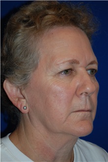 Eyelid Surgery Before Photo by Robert Kessler, MD; Corona Del Mar, CA - Case 35792