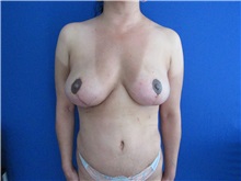 Breast Implant Removal After Photo by Trent Douglas, MD; Knoxville, TN - Case 35870
