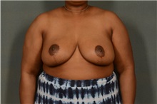 Breast Reduction After Photo by Ellen Janetzke, MD; ,  - Case 35969