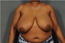 Breast Reduction Before Photo by Ellen Janetzke, MD; ,  - Case 35969