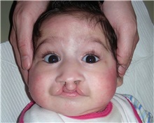Cleft Lip and Palate Repair Before Photo by Rachel Ruotolo, MD; Garden City, NY - Case 36039