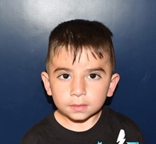 Craniosynostosis After Photo by Rachel Ruotolo, MD; Garden City, NY - Case 36058